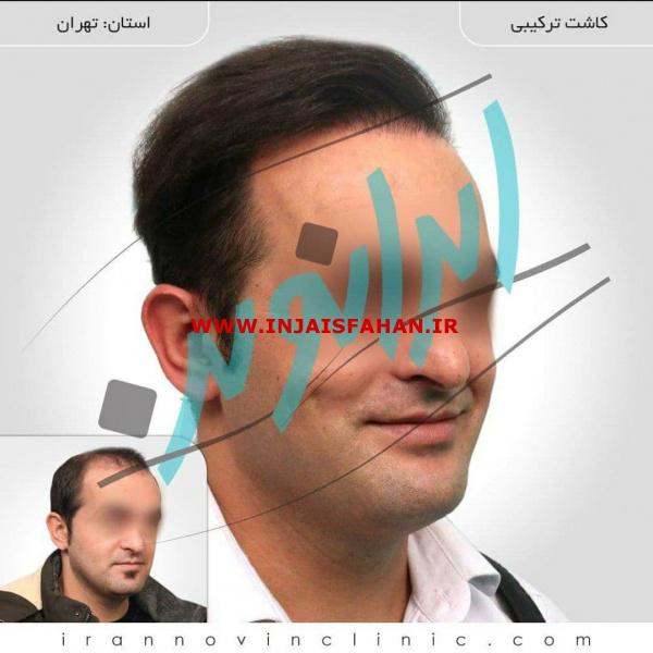 کاشت مو در ایران نوین تنها با دو و نیم میلیون تومان