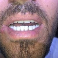 دندانسازی محلات